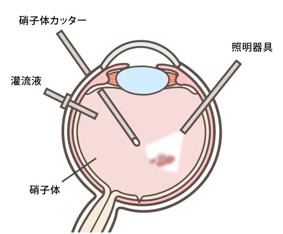 網膜硝子体手術2